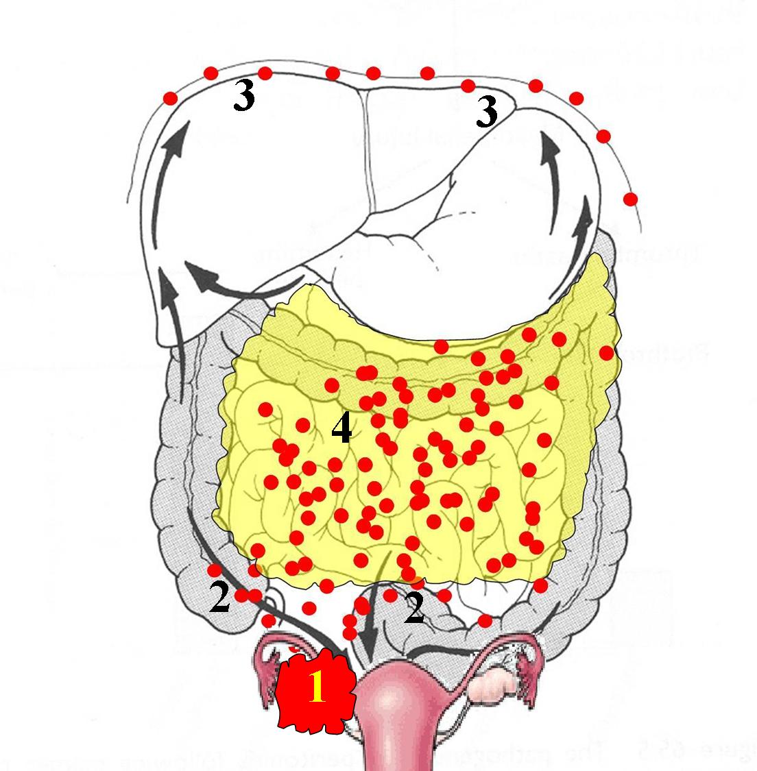 cancer peritoneal ventre gonfle